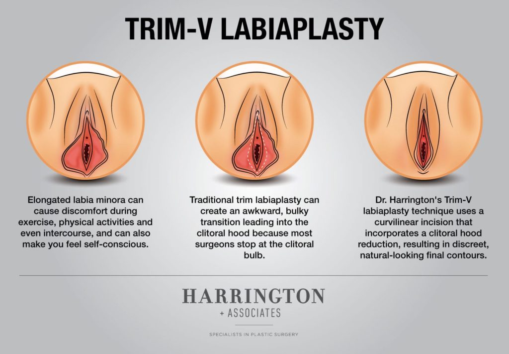 Labiaplasty img 1