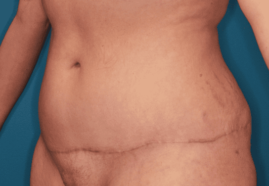 Tummy Tuck Patient Photo - Case 158 - after view-1